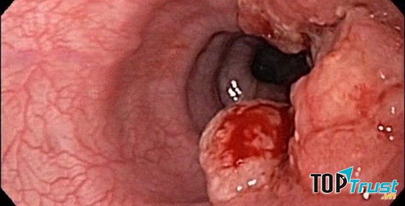 Hình ảnh thực quản bị ung thư