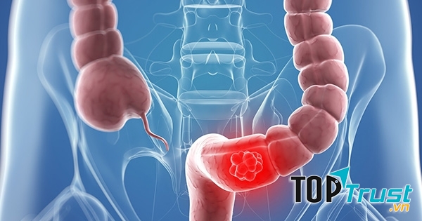 Ung thư trực tràng