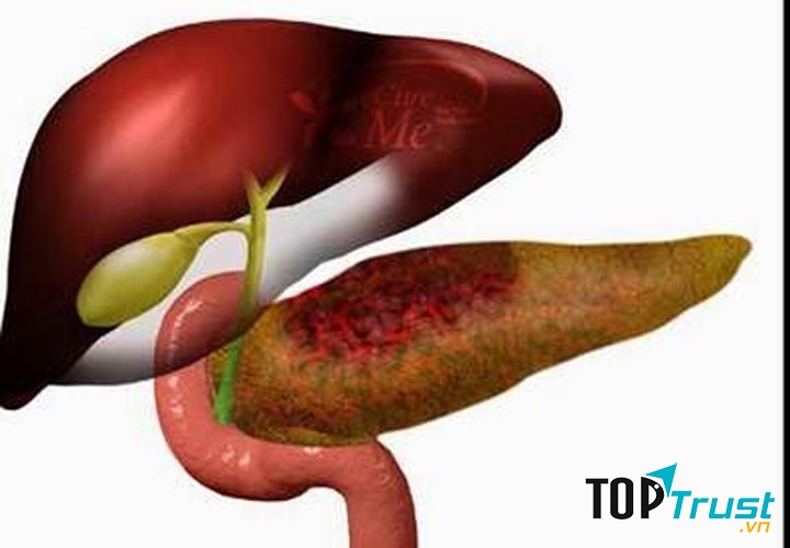 Hình ảnh phần tụy bị ung thư