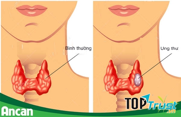 Ung thư tuyến giáp dễ phát hiện nên chúng ta có thể thường xuyên kiểm tra vùng cổ.