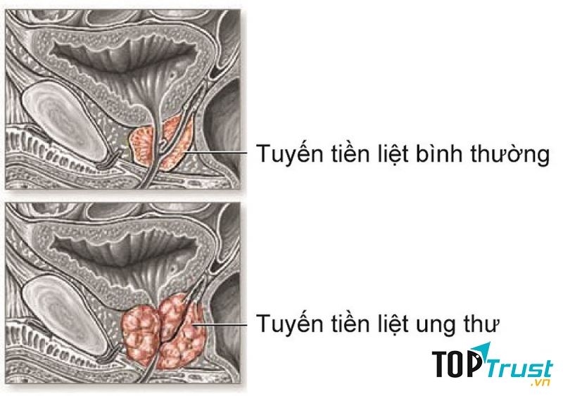 Ung thư tuyến tiền liệt