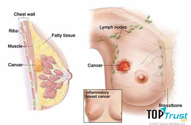 Hình ảnh khối ung thư trong vú