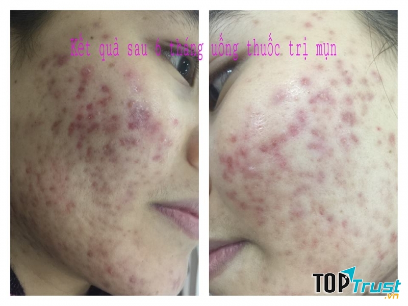 Sau khi chăm sóc, V - skin còn chuẩn bị thuốc cho khách sử dụng khi về nhà, tự chăm sóc bản thân.