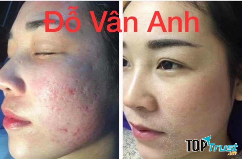 Khách hàng sử dụng dịch vụ trị sẹo rỗ tại spa