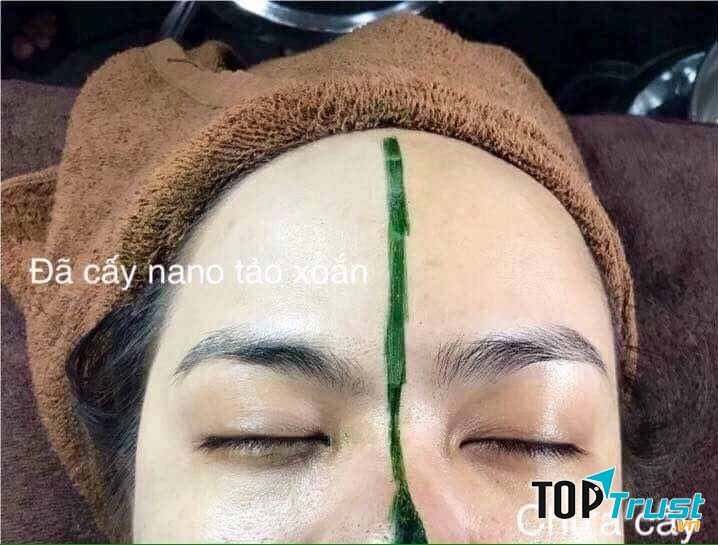 Khách hàng sử dụng dịch vụ cấy tảo xoắn tươi nano tại spa