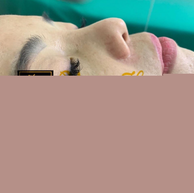 Vân Home - khách hàng trải nghiệm trước và sau nâng mũi