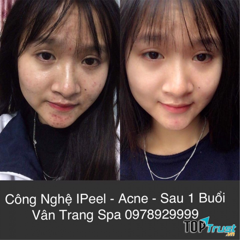 Khách hàng sau 1 buổi điều trị mụn tại Vân Trang Spa
