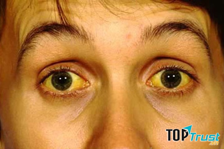 Vàng da, vàng mắt