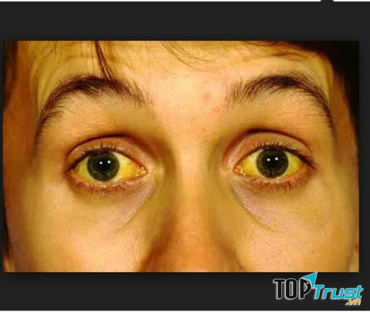 Vàng mắt - dấu hiệu cảnh báo viêm gan B điển hình