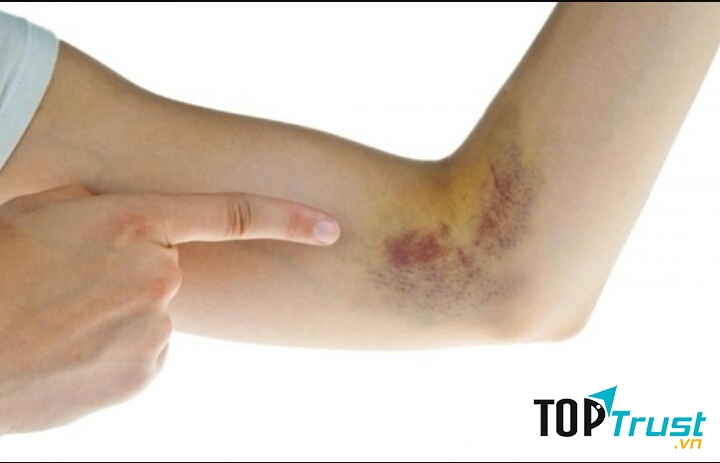 Vết thương lâu lành