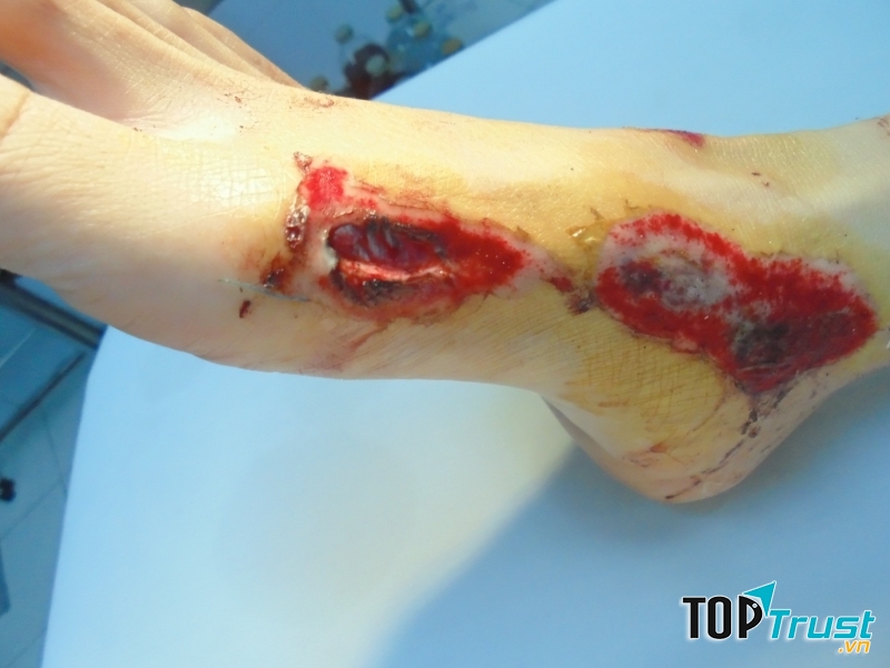 Vết thương ở chân lâu lành
