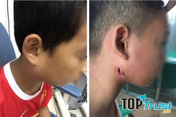 Vi khuẩn Whitmore ăn thịt người