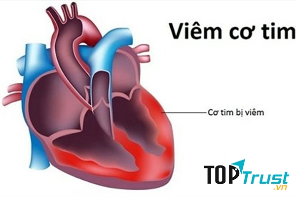 Cơ tim bị viêm