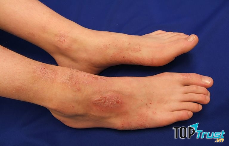 Điều trị dùng thuốc kem, mỡ corticoid nhẹ và vừa như hydrocortisone, betamethasone.