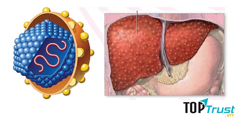 Viêm gan siêu vi B