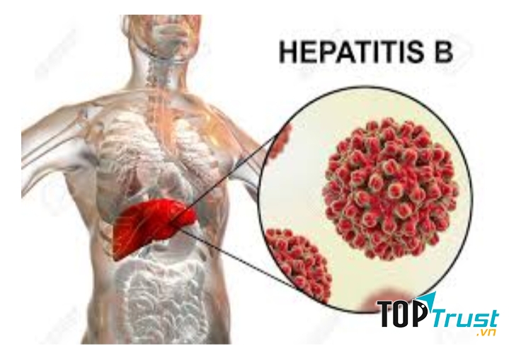 Bệnh viêm gan siêu vi B