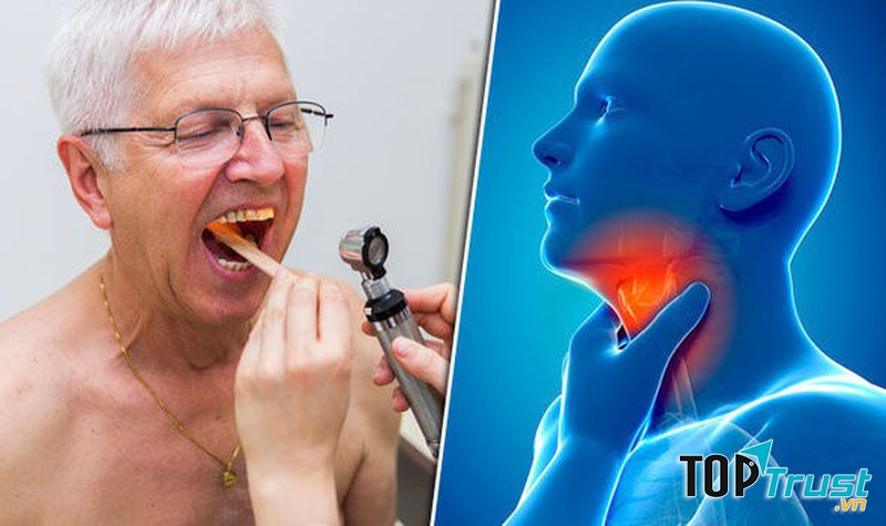 Đau họng, ho rát họng thường xuyên có thể do viêm họng mãn tính hoặc ung thư vòm họng