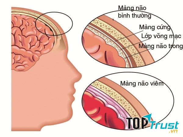 Viêm màng não mủ