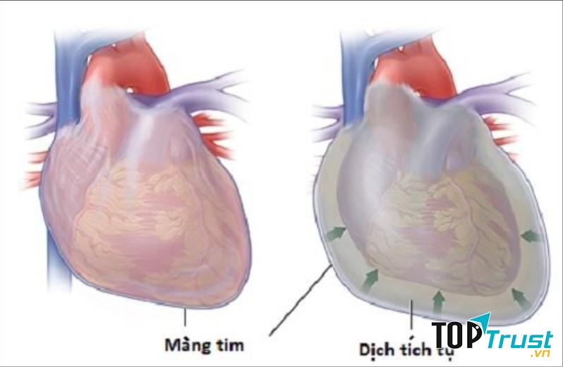 Viêm màng ngoài tim được hiểu là viêm kích thích của màng ngoài tim
