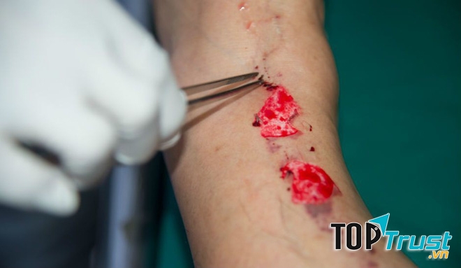 Viêm mô hoại tử (Necrotizing fasciitis)