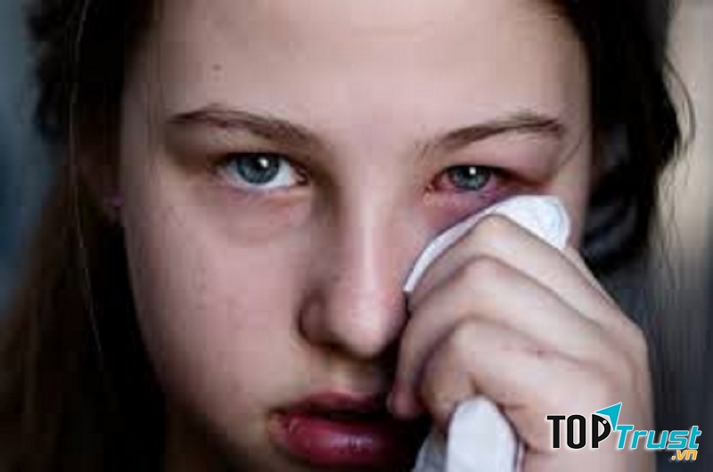 Viêm giác mạc cũng là một căn bệnh nguy hiểm ở trẻ nhỏ.