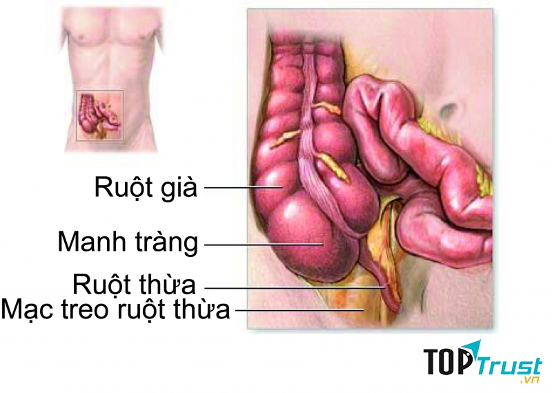 Viêm ruột thừa