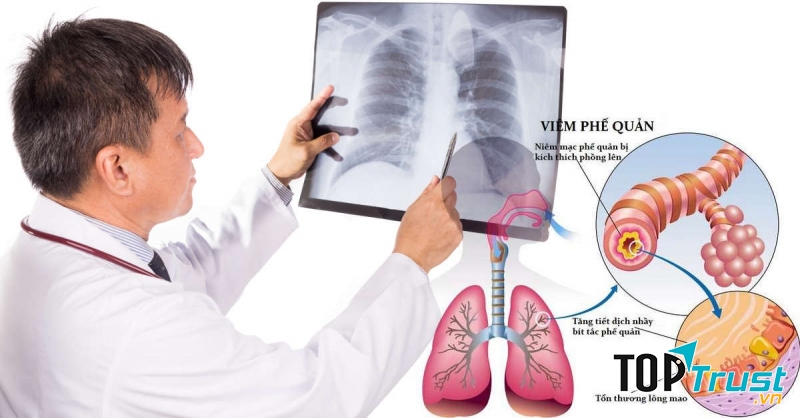 Viêm tiểu phế quản cấp