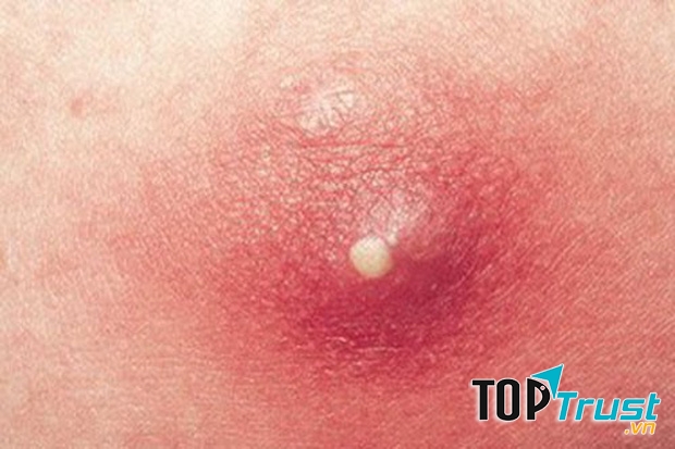 Triệu chứng ban đầu của bệnh là đau nhức tại vùng viêm và lân cận, khi nặng hơn sẽ gây viêm nhiễm nặng và xuất hiện mủ.