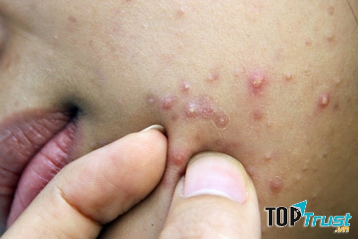 Viêm tuyến mồ hôi thường xuất hiện sâu trong da xung quanh các tuyến dầu và các nang tóc