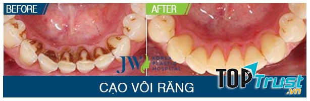 Kết quả thay đỗi rõ nét trước và sau lấy cao răng tại JW Hàn Quốc