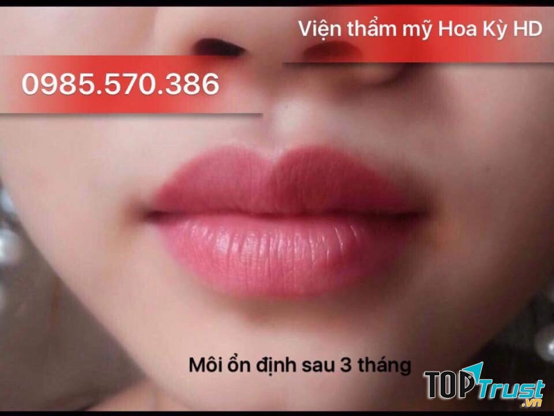 Môi của khách hàng sau 3 tháng phun môi