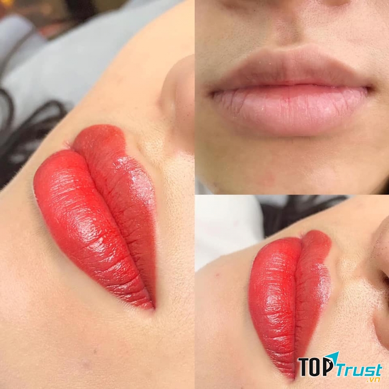 Phun môi ở thẩm mỹ viện Hoa Kỳ