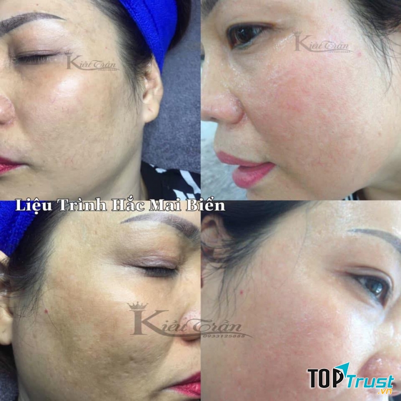 Trị nám tại Viện Thẩm Mỹ K Beauty