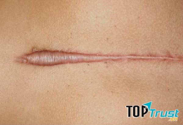 Điều trị sẹo lồi khoa học tại Koba cho kết quả vượt trội