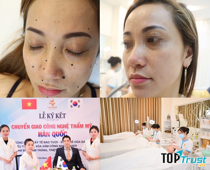 Kết quả tẩy xóa nốt ruồi tại Ladova