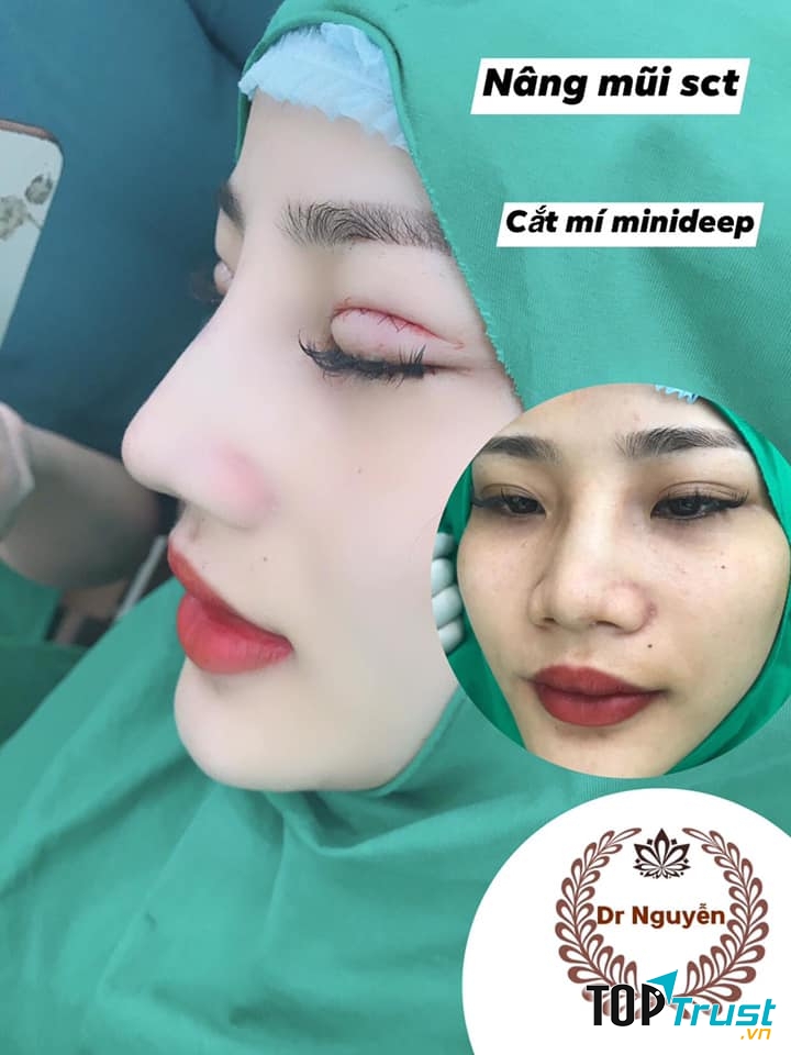 Cắt mí MINI DEEP tại Viện thẩm mỹ quốc tế Beauty Queen