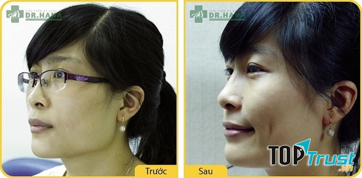 Khách hàng tạo má lúm tại DR Hana