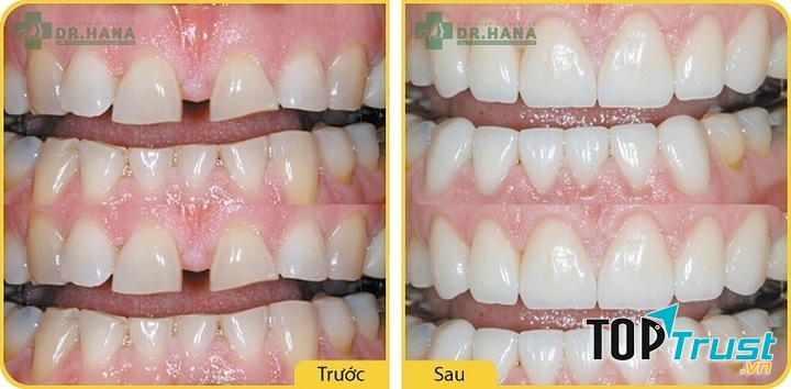 Kết quả sau hàn trám tại Viện thẩm mỹ quốc tế Dr. Hana