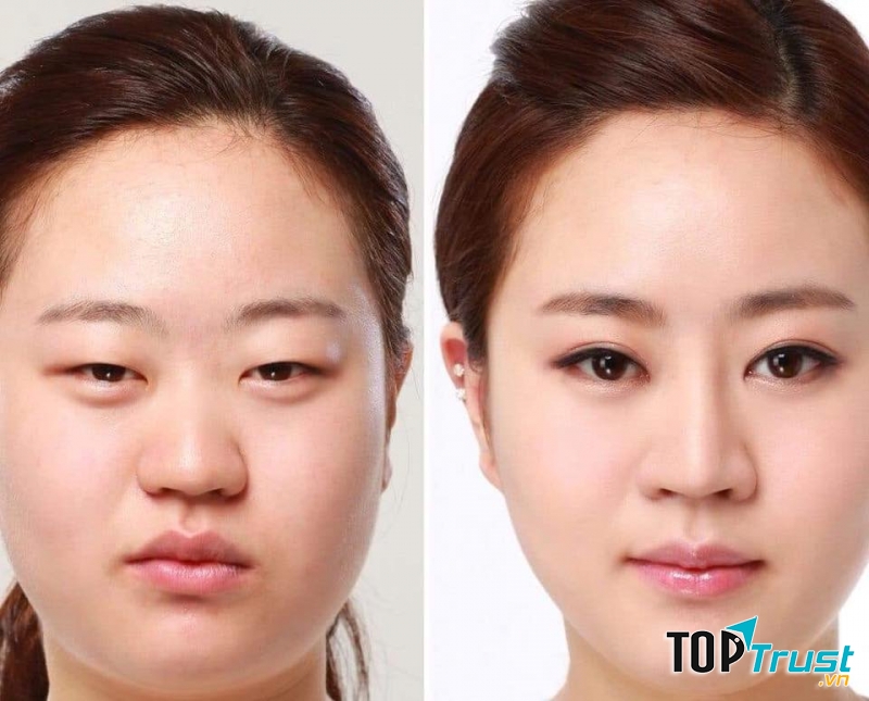 Hình ảnh trước và sau khi cắt mí tại Viện thẩm mỹ Quốc tế GEN-X CLINIC