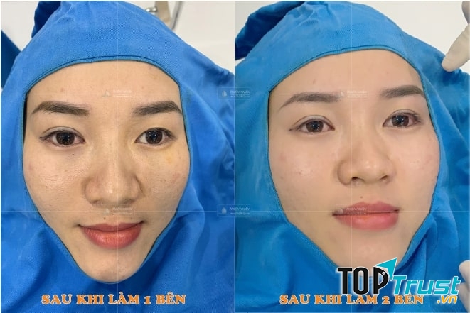 Hiệu quả từ khách hàng sau khi nhấn mí tại Viện thẩm mỹ Thiện Nhân