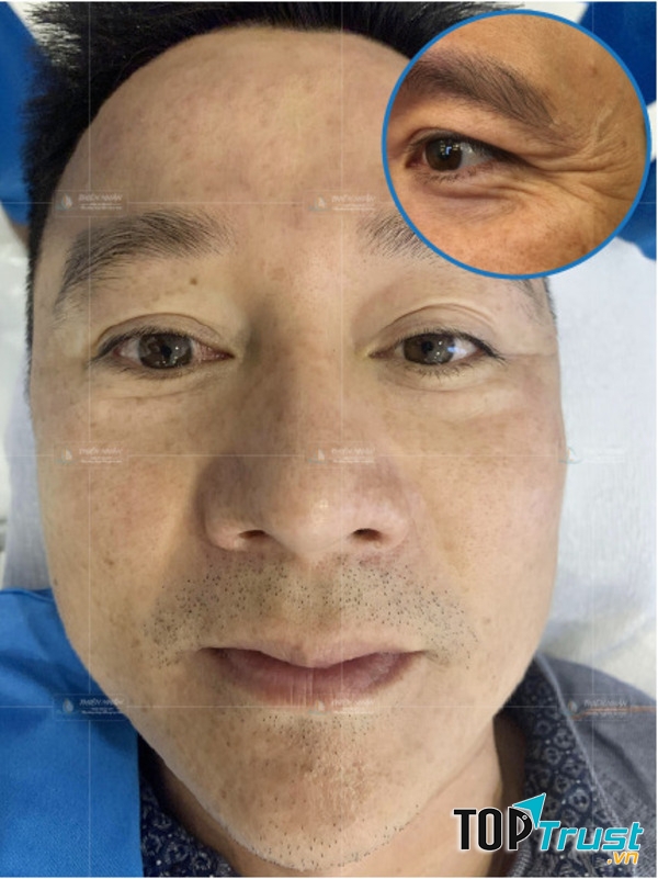 Hiệu quả từ khách hàng sau khi tiêm xóa nhăn đuôi mắt tại VTM Thiện Nhân