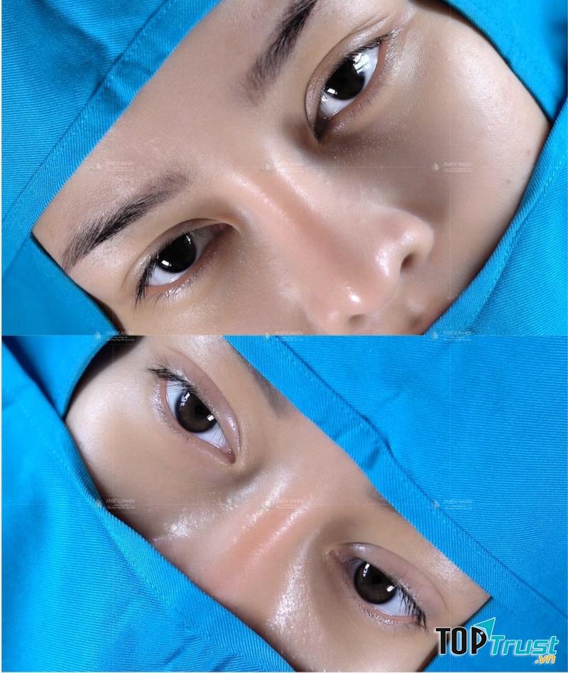 Khách hàng sở hữu đôi mắt 2 mí đẹp tự nhiên, không lo sẹo xấu sau cắt mí B Eyes