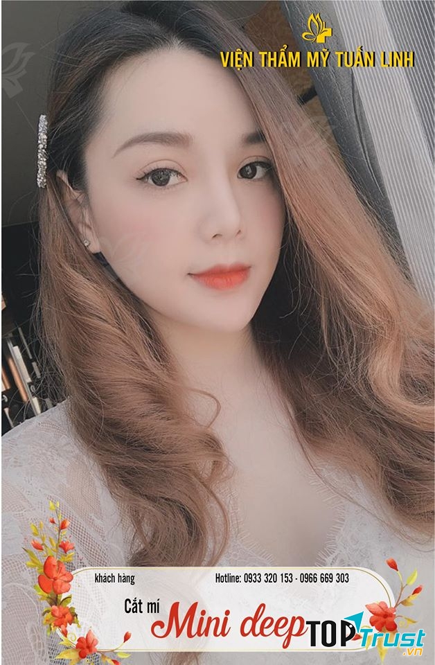 Cắt mí MINI DEEP tại Viện thẩm mỹ Tuấn Linh