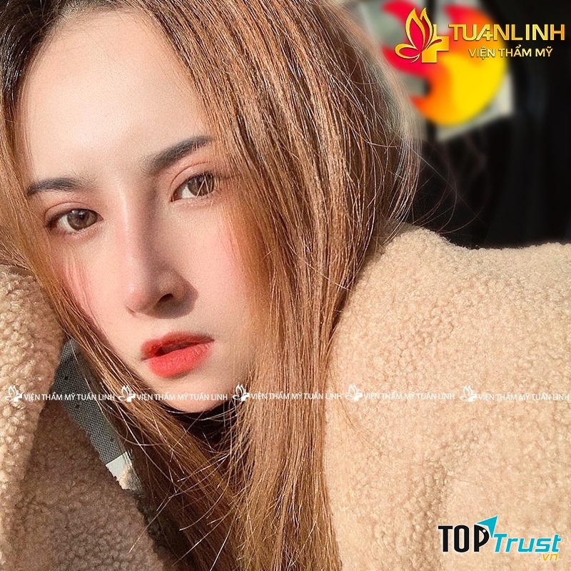 Trải nghiệm cắt mí Plasma tại Viện thẩm mỹ Tuấn Linh