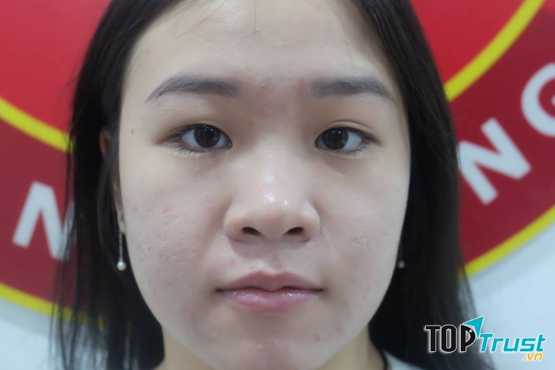 Trước khi cắt mí