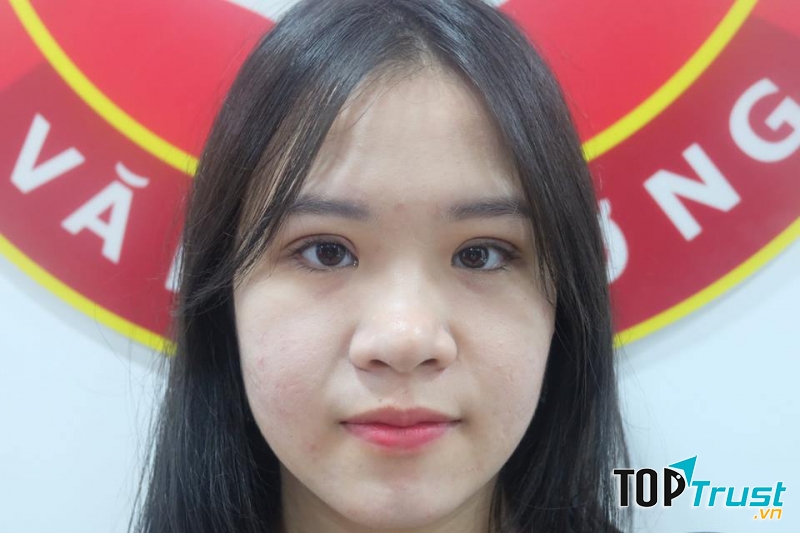 Sau khi cắt mí tại Viện Thẩm Mỹ Văn Trường