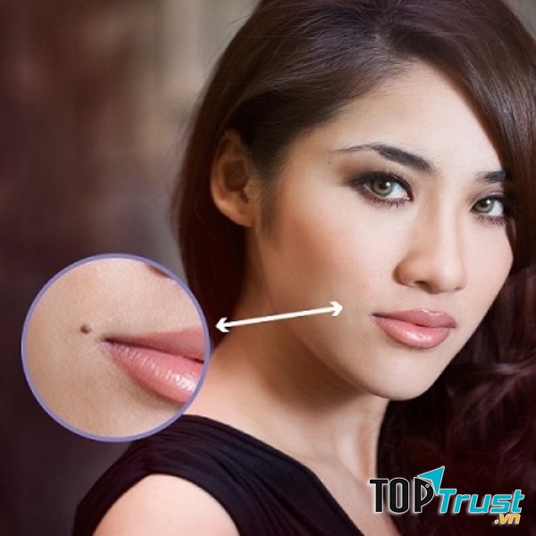 Hình ảnh trước và sau khi tẩy nốt ruồi , cho bạn vẻ đẹp không tỳ vết