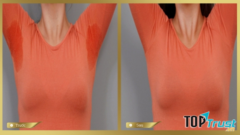 Bệnh hôi nách không còn ám ảnh