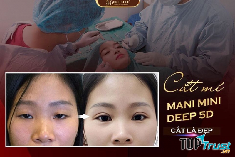 Cắt mí MANI MINI DEEP 5D tại Viện thẩm mỹ Y khoa Dr.Hải Lê