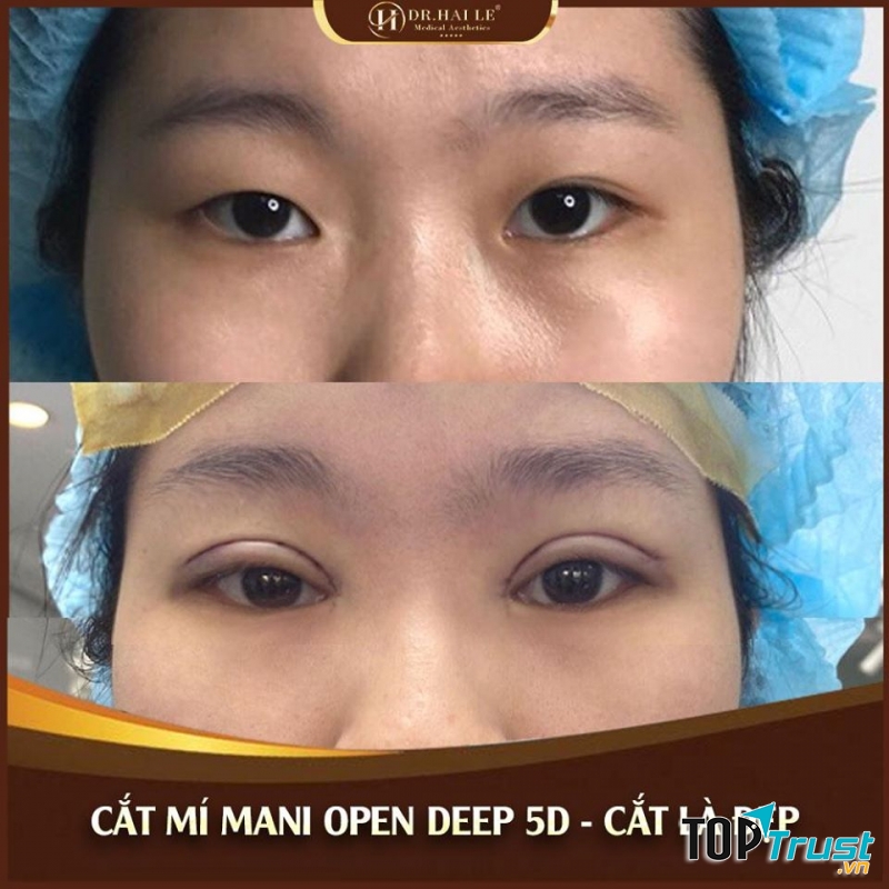 Cắt mí MANI OPEN DEEP 5D tại Viện thẩm mỹ Y khoa Dr.Hải Lê